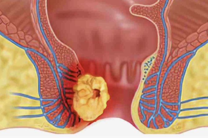 Care sunt tipurile de fistule anale?
