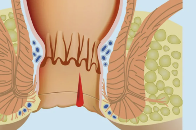 Care sunt cauzele durerii cauzate de hemoroizi?