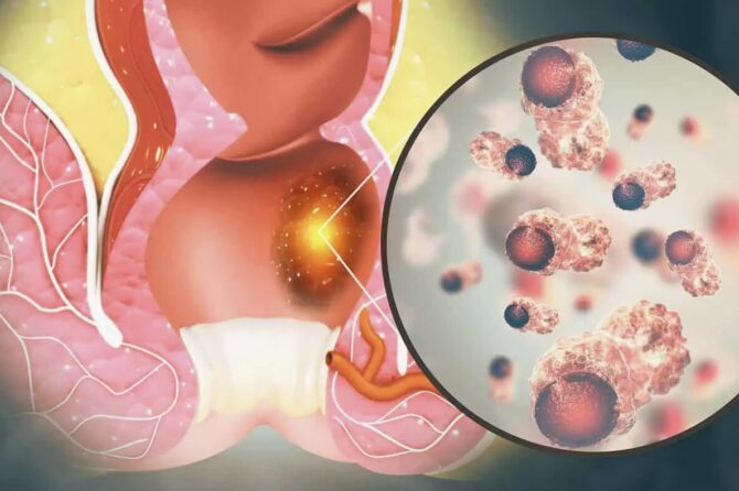 Abordări Combinate de Tratament pentru Hemoroizii Persistenți