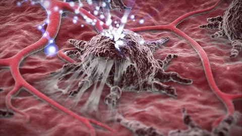 Polipul Anal Este Periculos? Se Transformă în Cancer?