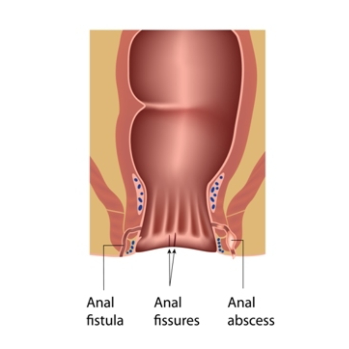 anal-fistula