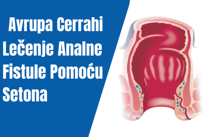 Lečenje Analne Fistule Pomoću Setona