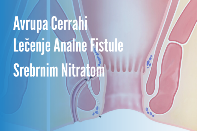 Lečenje Analne Fistule Srebrnim Nitratom