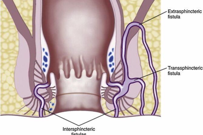 Šta Pomaže Kod Analne Fistule?