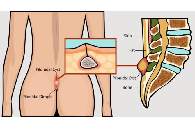 Šta Pomaže Kod Pilonidalnog Sinusa?