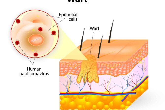 Šta Dobro Deluje Za Genitalne Bradavice?