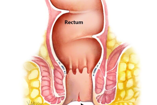 Koliko Dugo Traje Proces Zarastanja Analne Fisure?