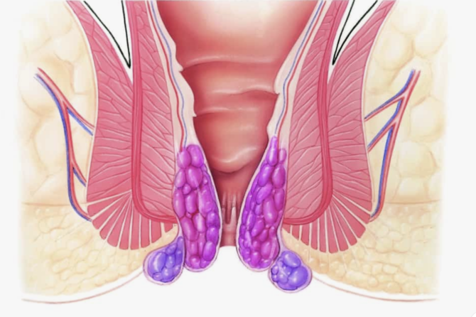 Koje Su Metode Lečenja Hemoroida?