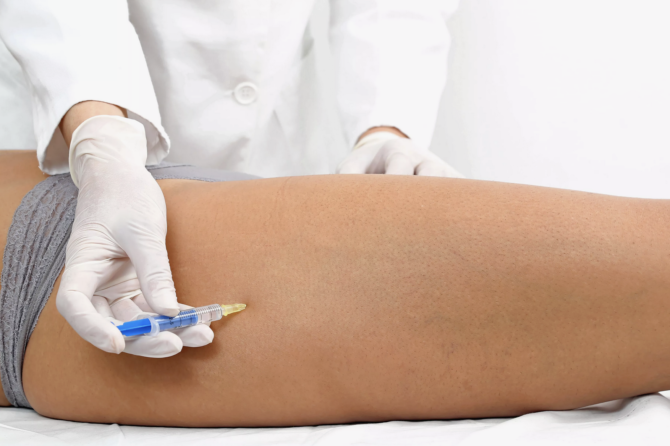 Šta Je Skleroterapija?