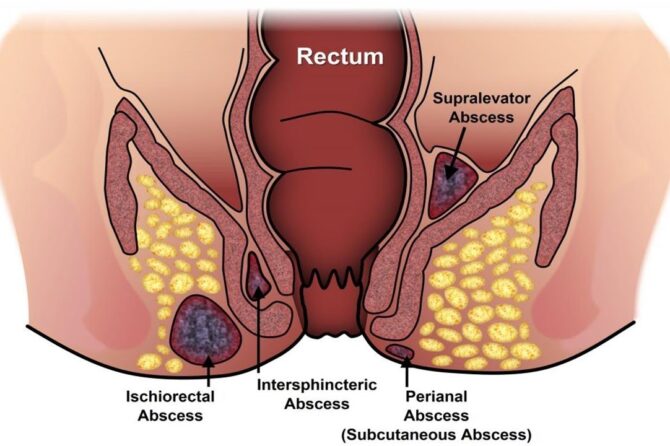 Koje Bolesti Su Indikovane Oticanjem U Analnom Području?