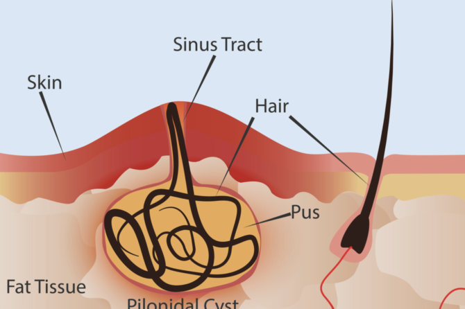 6 Simptoma Pilonidalnog Sinusa I Sta Treba Učiniti