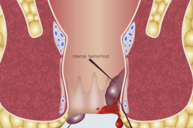 6 Simptoma Analne Disure I Sta Treba Učiniti