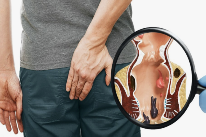 Kako Se Izvodi Nehirurško Lečenje Hemoroida?