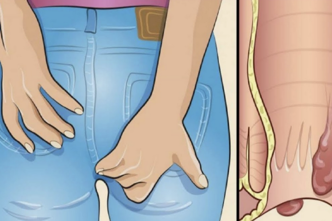 Nehirurško Liječenje Analnih Fisura?