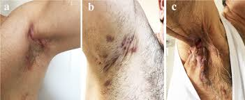 Gnojni hidradenitis (HS)