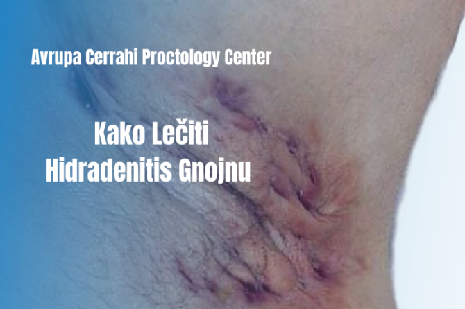 Kako Prirodno Lečiti Hidradenitis Gnojnu Bolest?