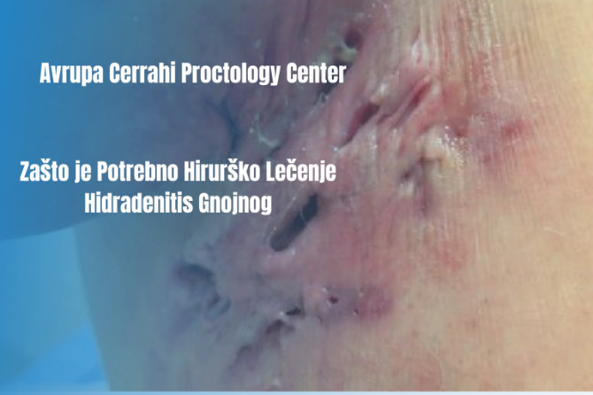 Hirurško Lečenje Hidradenitisa Suppurativa: Kada I Kako Se Izvodi?