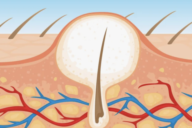 Nehiruşko Lasersko Lečenje Pilonidalnog Sinusa
