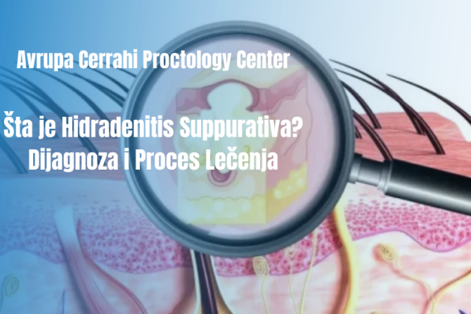 Šta Je Hidradenitis Suppurativa? Dijagnoza I Proces Lečenja