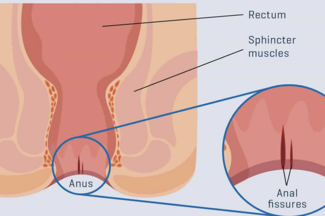 Koliko Dugo Traje Operacija Hemoroida?