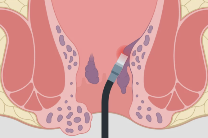 Šta Je Hemoroidektomija?