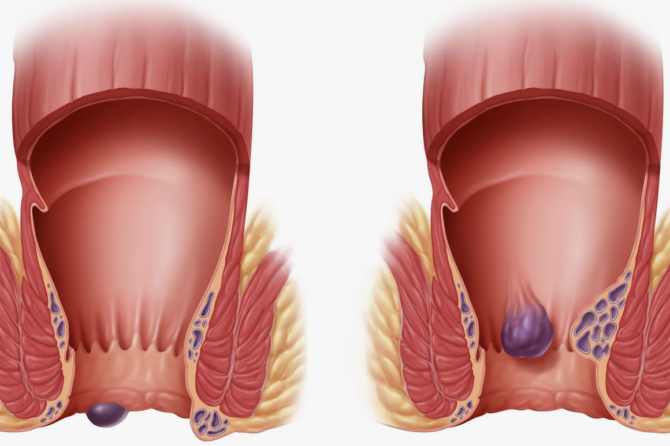 Šta Je Dobro Za Hemoroide?