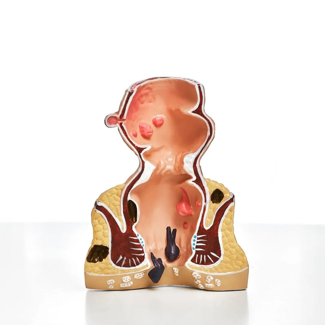 anal-fistul-kansere-cevirir-mi