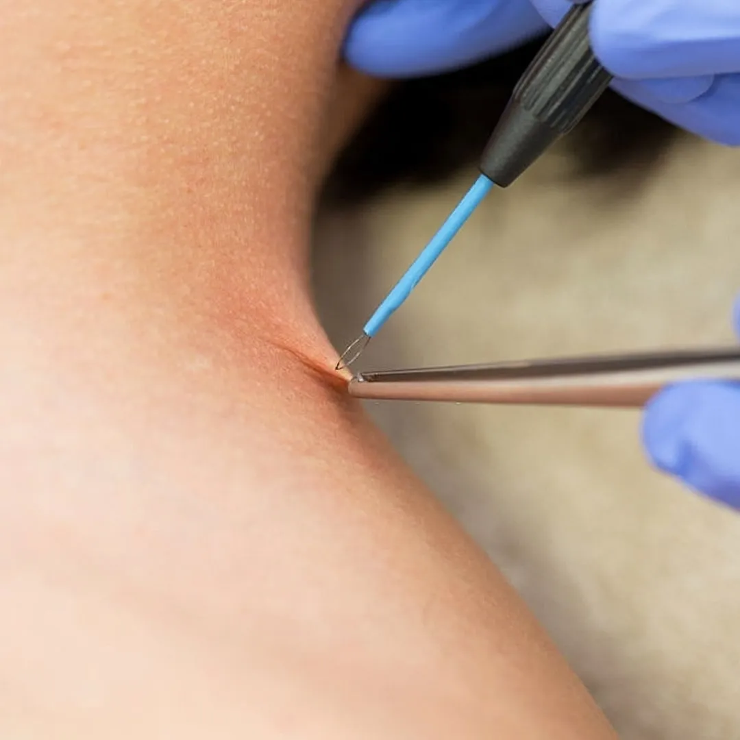 genital-sigil-kimlerde-gorulur