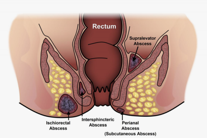 Kada Osećaj Kvržice u Analnom Području Treba Shvatiti Ozbiljno?