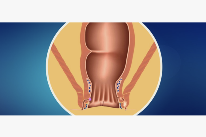 Kako Prepoznati Analni Apsces?