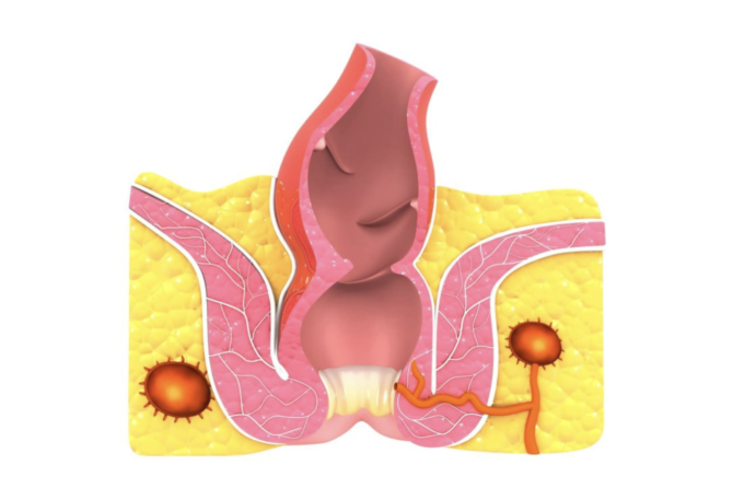 Šta Je Analni Polip, Zašto Se Javlja I Kako Se Leči?