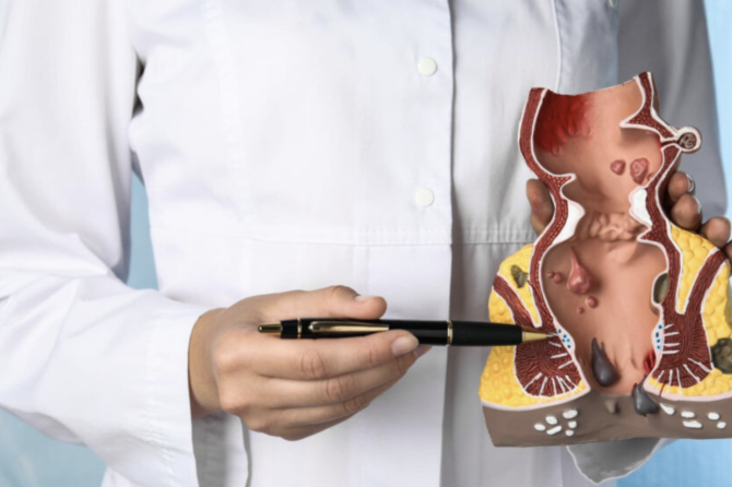 Zašto Se Javlja Analna Fistula?