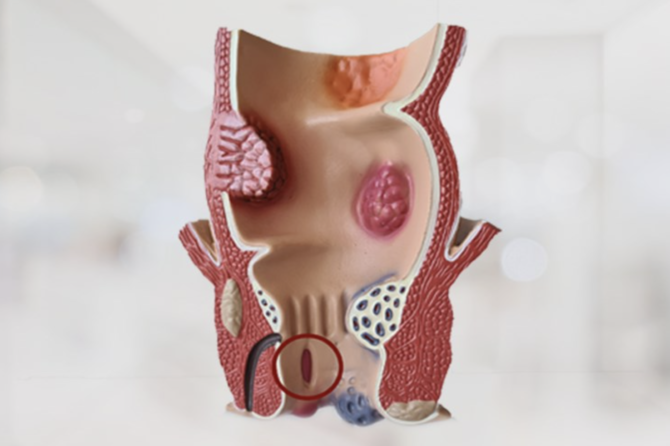 Zašto Je Ishrana Važna Za Pacijente Sa Analnom Fisurom?