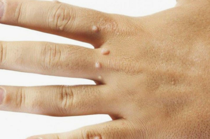 Jačanje Imunog Sistema