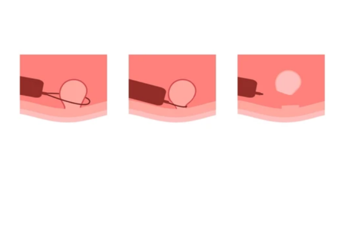 Kako se Vrši Lečenje Analnih Polipa? Da li je Operacija Neophodna? Meta Opis