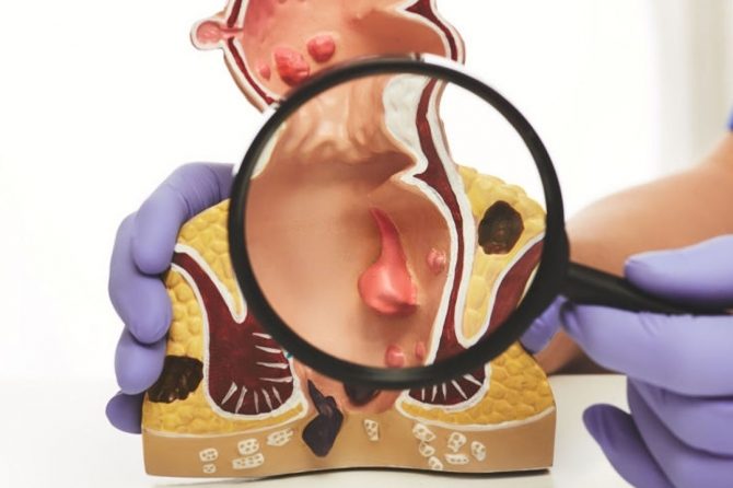 Пройдёт ли геморрой сам??