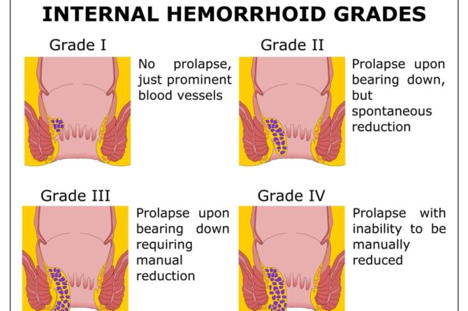 Сколько времени занимает процесс выздоровления после лечения геморроя?