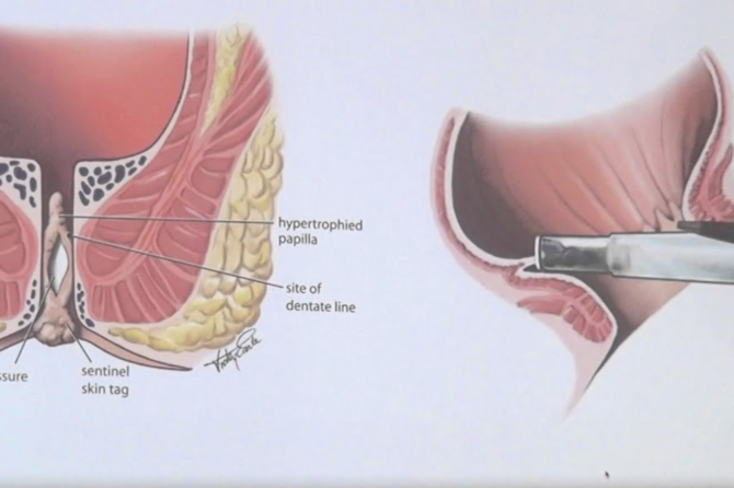 Что такое Лигирование с помощью резинки?