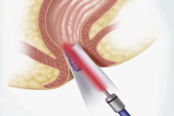 Что такое лазерное лечение анальной трещины?