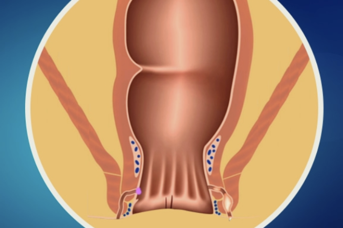 Сколько Стоит Лечение Геморроя в Турции?