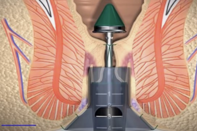 Как проводится безоперационная эстетика анальной области?