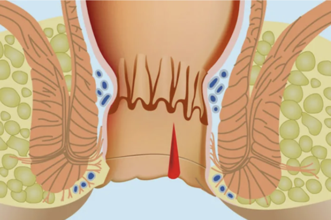 Могут ли Геморрои Проходить Сами?