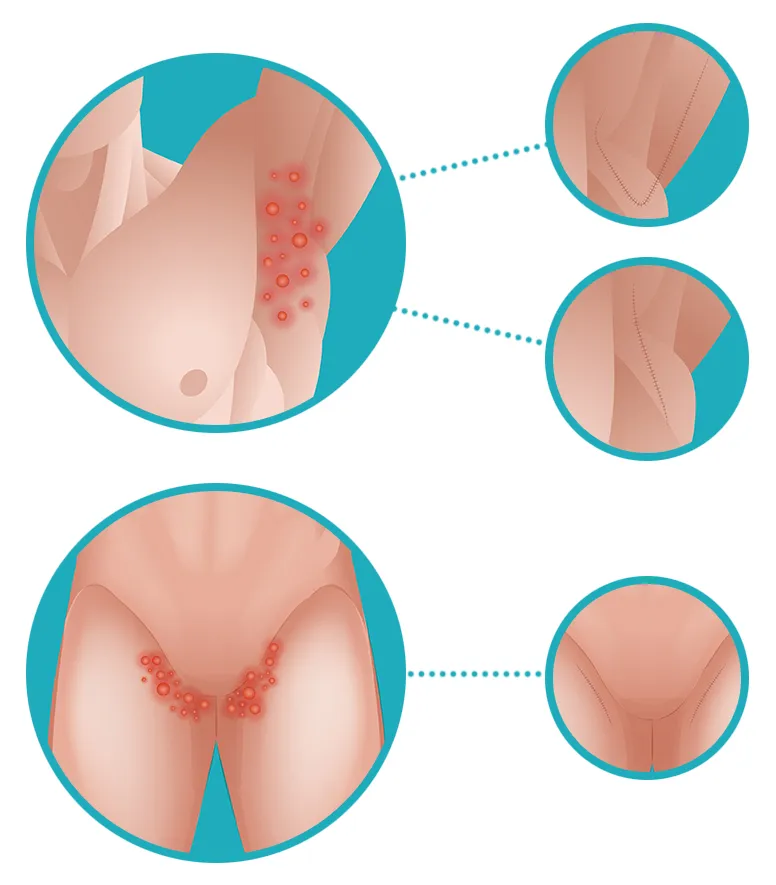 Hidradenitis Suppurativa