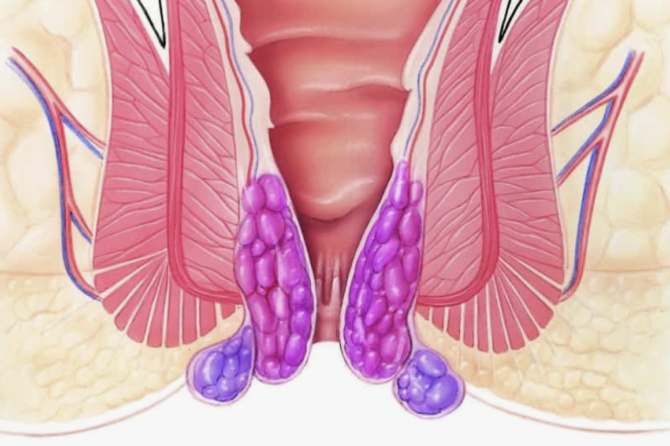 Что такое тромбированный геморрой и как его лечить?