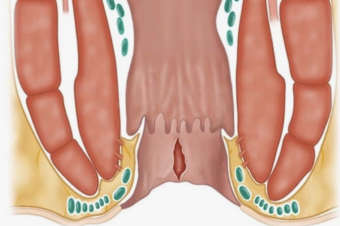 Что такое анальная бахромка, почему она появляется и что помогает?