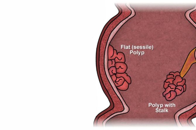 Как диагностируются анальные полипы? Процесс обследования и диагностики